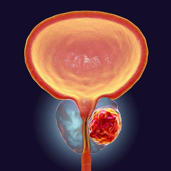 Medizinische Illustration der Harnblase und Prostata; die Prostata ist vergrößert, rechts sitzt ein rot markierter Tumor, der die Harnröhre umgibt – Darstellung von Prostatakrebs.